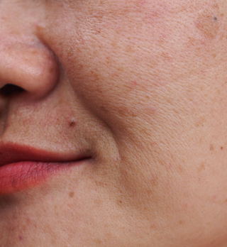 HOW TO GET RID OF DARK SPOTS ON YOUR FACE