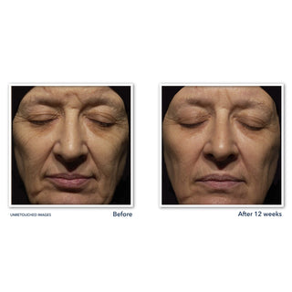 RETINOL CORREXION® Deep Wrinkle Night Cream:Before and After after 12 weeks