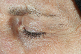 Before photo for dual eye cream. Shows eye and under eye of consumer