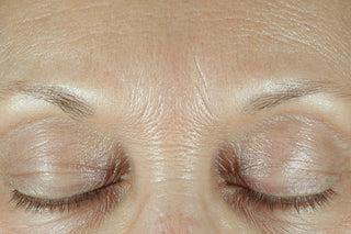 Client's Frown lines instantly after using fill + Treat