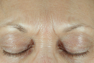 Client's Frown lines before using fill + Treat