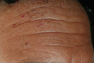 before image of a forehead