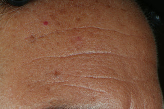 4 week after photo of a forehead