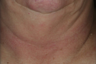 After (4 weeks) photo for Firming Stick. Shows neck of consumer