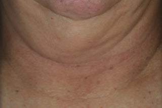 Before photo for Firming Stick. Shows neck of consumer
