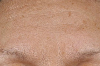 Close-up of a person's forehead with visible skin texture and lines.