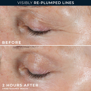 visibly re-plumped lines