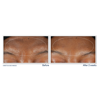 RETINOL CORREXION® Deep Wrinkle Serum Cleanser Before and after image of participant's forehead showing visible reduction in forehead texture after 2 weeks of use