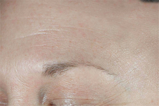 After photo of a clients forehead