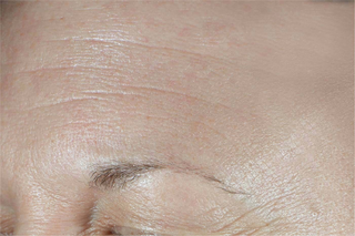 Before Image of the forehead of a consumer