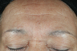 Hydration+ Serum is clinically proven to deliver results. There are unretouched before and after images shown. The before image shows deep forehead wrinkles.