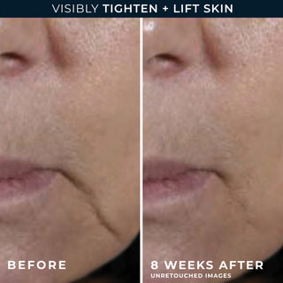 visibly tighten + lift skin before and after 8 weeks