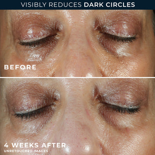MULTI CORREXION® Even Tone + Lift Eye Cream Before and after image of participant's eye area showing a visible reduction in under eye darkness.