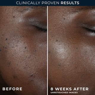 MULTI CORREXION® Even Tone + Lift Night Cream Before and after image of participant's cheek showing visibly smoother skin tone after 8 weeks of use.