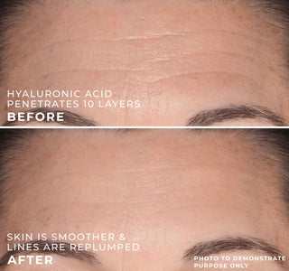 hyaluronic acid penetrates 10 layers | before
skin is smoother & lines are replumped | after
photo to demonstrate purpose only