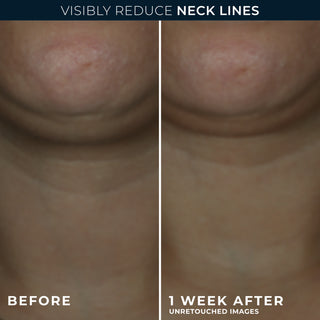 visibly reduce neck lines
Before and after 1 week