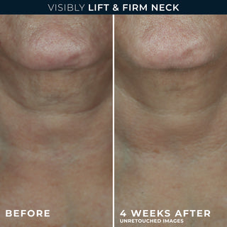 visibly firm & lift neck
Before and after 4 week
