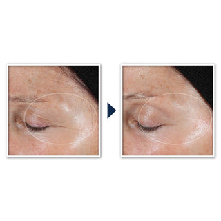 RETINOL CORREXION® Deep Wrinkle Targeted Patches Before and after image of participant's outer eye area showing a visible reduction in crow's feet lines after one use