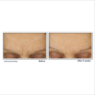 RETINOL CORREXION® Line Smoothing Max Hydration Cream Before & After image of customer forehead showing reduction of horizontal "11" lines between eyes.