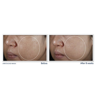 MULTI CORREXION® Even Tone + Lift Night Cream Before and after image of participant's cheek showing visible reduction in skin discoloration.