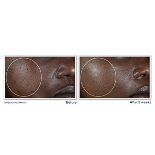 MULTI CORREXION® Even Tone + Lift Night Cream Before and after image of participant's cheek showing visibly smoother skin tone after 8 weeks of use.