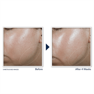 Before and After images of study participant cheek showing visibly firmer skin of jawline after 4 weeks of use