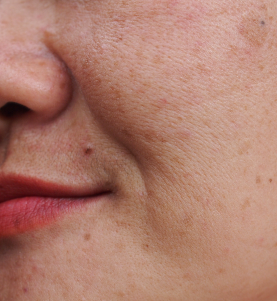 Dark Spot Remover, Aged Spots, Perfect Glowing Skin, brightening facial  serum
