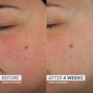 Unretouched Before+ After images showing a Barrier Renew clinical study participants cheek showing a reduction of redness after 4 weeks of use. 