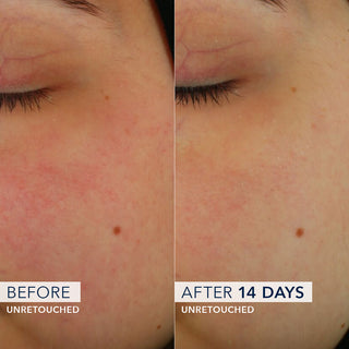 Image of clinical participant showing reduction in redness and increased hydration on cheek after 14 days of use.