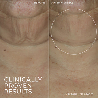 Image of DERM CORREXION® Firming Serum Stick clinical study participant neck showing increased firmness after 4 weeks of use. 