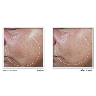 Image of DERM CORREXION® Firming Serum Stick clinical study participants cheek showing increased firmness after 1 week of use. 