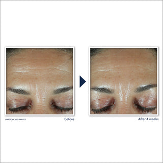 RETINOL CORREXION® Deep Wrinkle Filler Before and After after 4 weeks