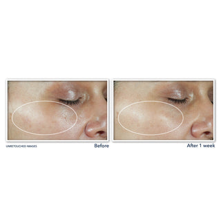 Before and After Image of clinical study participant showing improvement in the texture of skin on cheek after using MULTI CORREXION® Revive + Glow Moisturizer SPF 30 for 1 week.