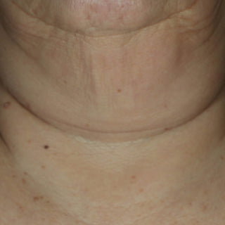 Close-up of a person's neck and lower face showing skin texture, wrinkles, and freckles.
