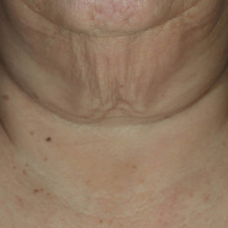 Close-up of a person's neck and lower face showing skin texture, wrinkles, and freckles.