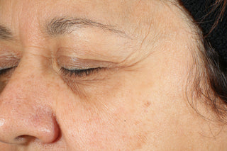Before photo for revive + glow daily serum. Shows eye and under eye of consumer