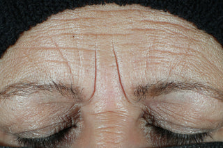 Before photo for hydrate + plump daily moisturizer. Shows forehead of consumer