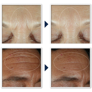 RoC Clinically Proven Skincare Before & After Results for Derm Correxion Fill + Treat Serum