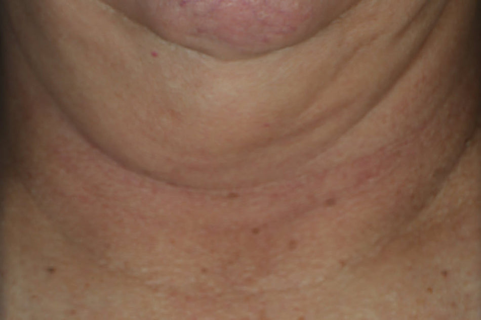 DERM CORREXION® Firming Serum Stick RoC® Skincare
