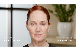 Mary eye age was 66 and is now 59 years old. For a befoie and after image that shows an eye age reduction of -7 years