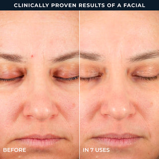 Clinically proven results of a facial
Before 
In 7 uses