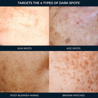 Targets the 4 types of dark spots* (sun spots, age spots, post-blemish marks, brown patches) *Depicts targeted dark spots. Results not shown.