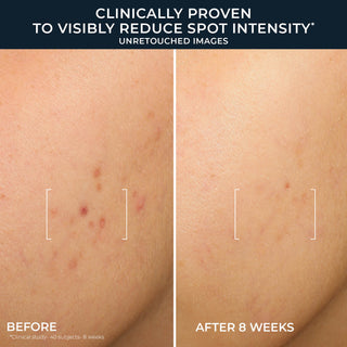 Before-and-after skin comparison showing acne spots and redness reduction over 8 weeks, with text reading 'Clinically Proven to Visibly Reduce Spot Intensity' and 'Before' and 'After 8 Weeks'.