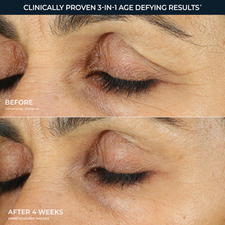 Before and after comparison of eye area skin texture with text indicating clinical results.