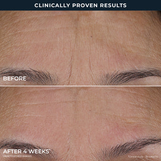 Before and after  4 weeks* comparison of skin texture on a forehead with text 'Clinically Proven Results'.
Unretouched images 
*clinical study- 29 subjects