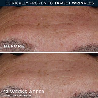 Deep wrinkle serum is clinically proven to target wrinkles. this is a before and after image of someone after using the deep wrinkle serum after 12 weeks