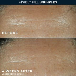 before and 4 weeks after