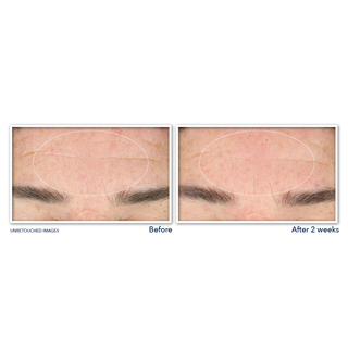 RETINOL CORREXION® Deep Wrinkle Serum Cleanser Before and after image of participant's forehead showing visible reduction in fine lines after 2 weeks of use.