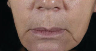 Before using MULTI CORREXION® Firm + Lift Anti-Sagging Firming Cream for 8 weeks. There are pronounced frown wrinkles and sagging.