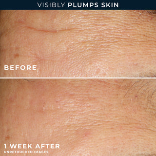 Visibly Plumps Skin
Before After